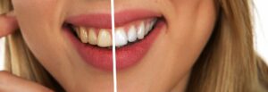Metody wybielania zębów – które z nich są skuteczne?