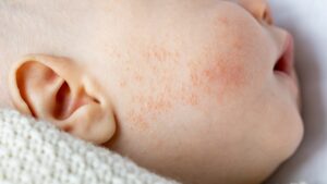 Objawy alergii u niemowląt: co warto wiedzieć?