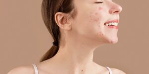 Zdrowa skóra – zabiegi kosmetyczne dla cery trądzikowej